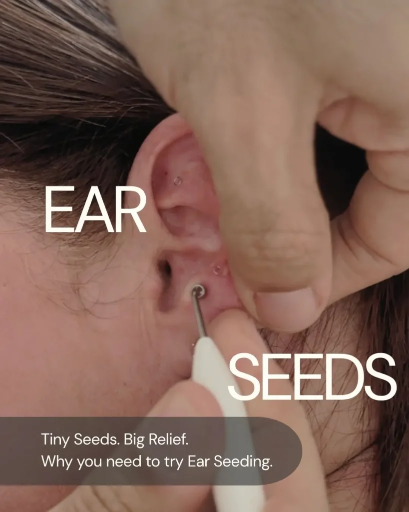 Auriculotherapy Ear Seeding at Excelsius Wellness